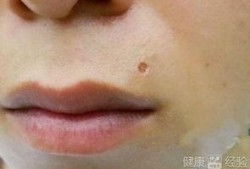 给吃瓜男孩点痣视频