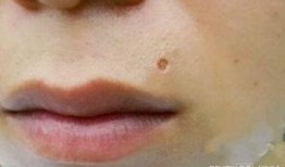 给吃瓜男孩点痣视频